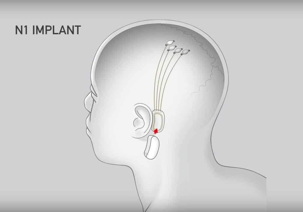 Neuralink, Elon Musk's Magical Solution