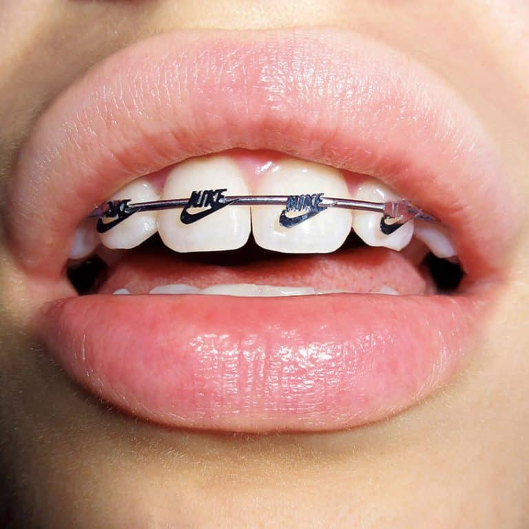 Interview with Gab Bois Bright smile with Nike-branded orthodontic braces on upper teeth.